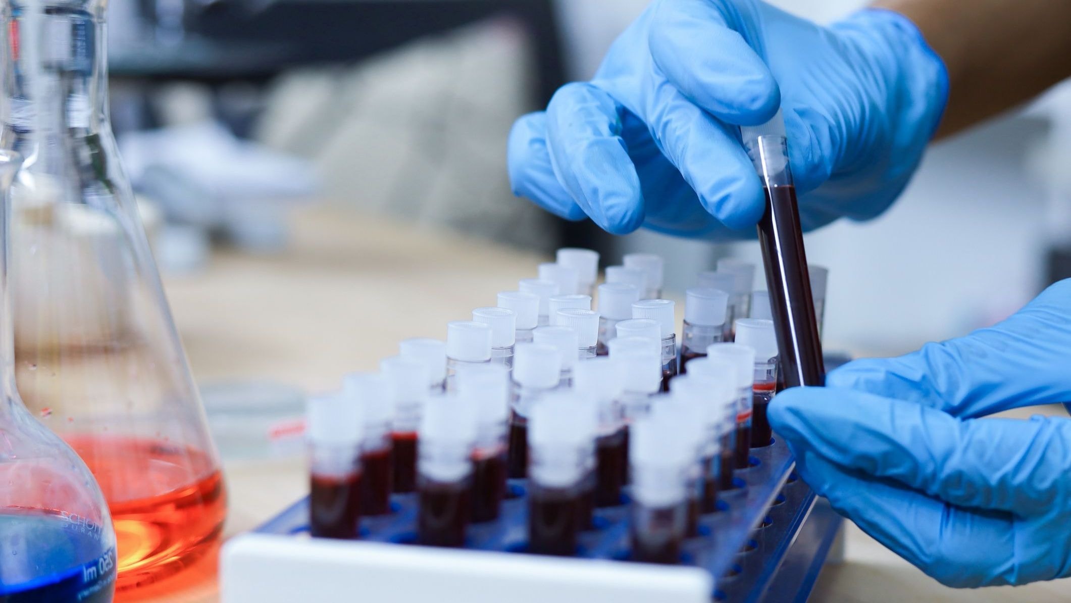 Alzheimer: neurologistas explicam caso de demência precoce a Dr. Kalil