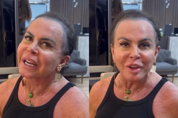 Transplante de Gretchen por alopecia: médicos explicam queda de cabelo