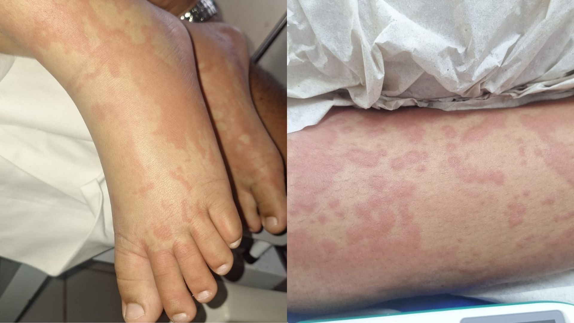 Suspeita de contaminação por detergente: saiba quadro de criança internada