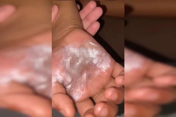 Mãe aquece colher no fogão e queima mãos do filho de propósito no Entorno