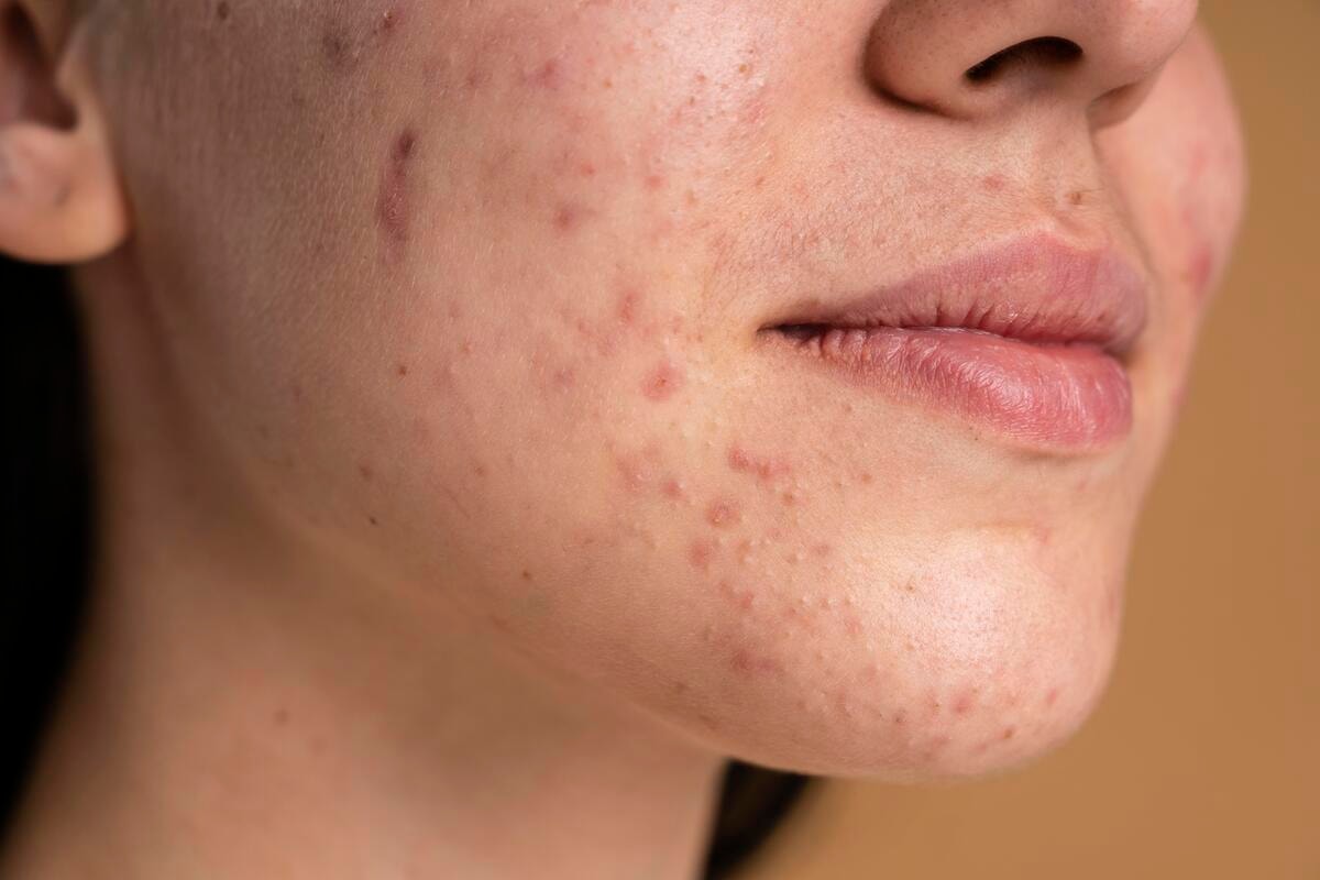 Espremer espinhas profundas aumenta o risco de infecção e cicatrizes