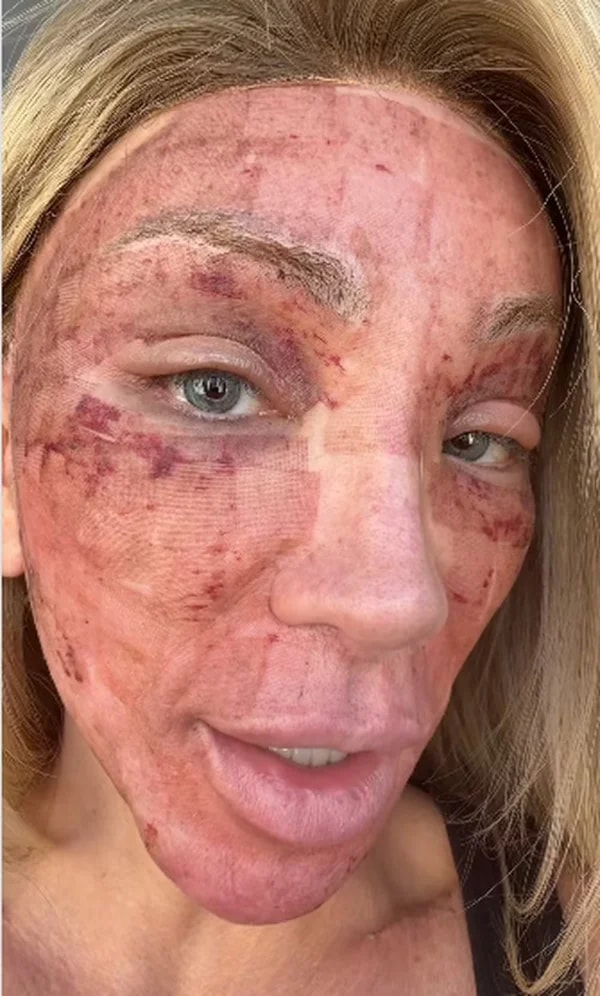 Peeling: dermatologista explica procedimento feito por Maya Massafera