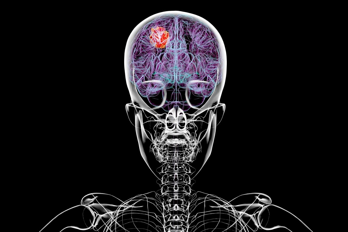 Pesquisa associa alguns contraceptivos a maior risco de tumor cerebral