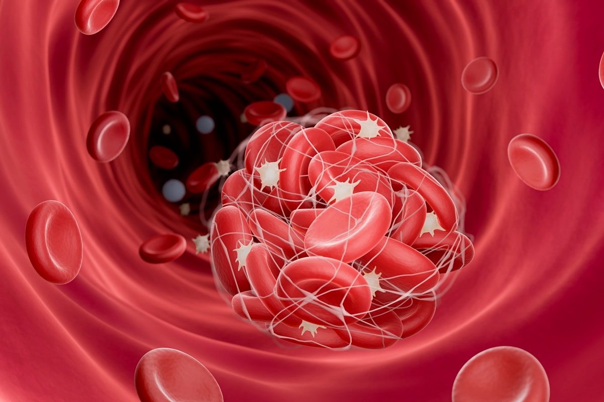 Médico vascular aponta fatores de risco e o que ajuda a prevenir a trombose