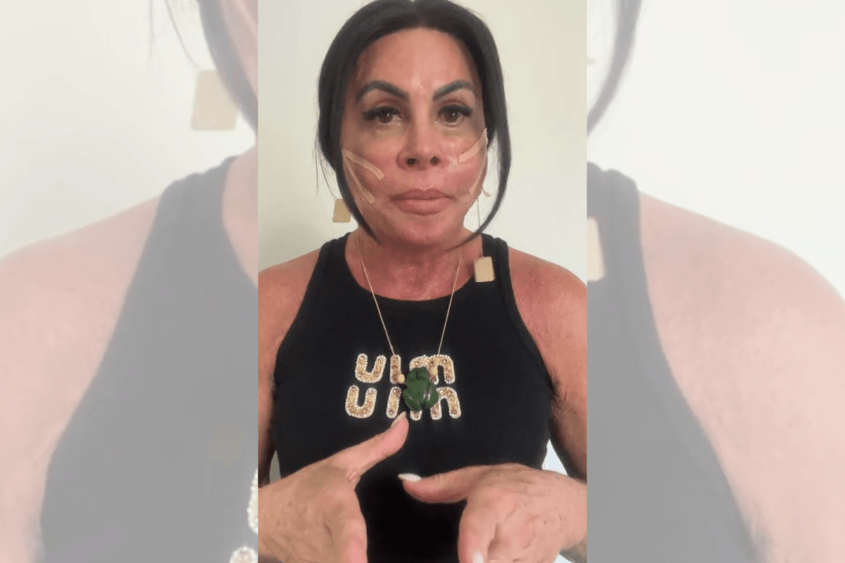 Gretchen aplica fios de sustentação no rosto; médica explica técnica