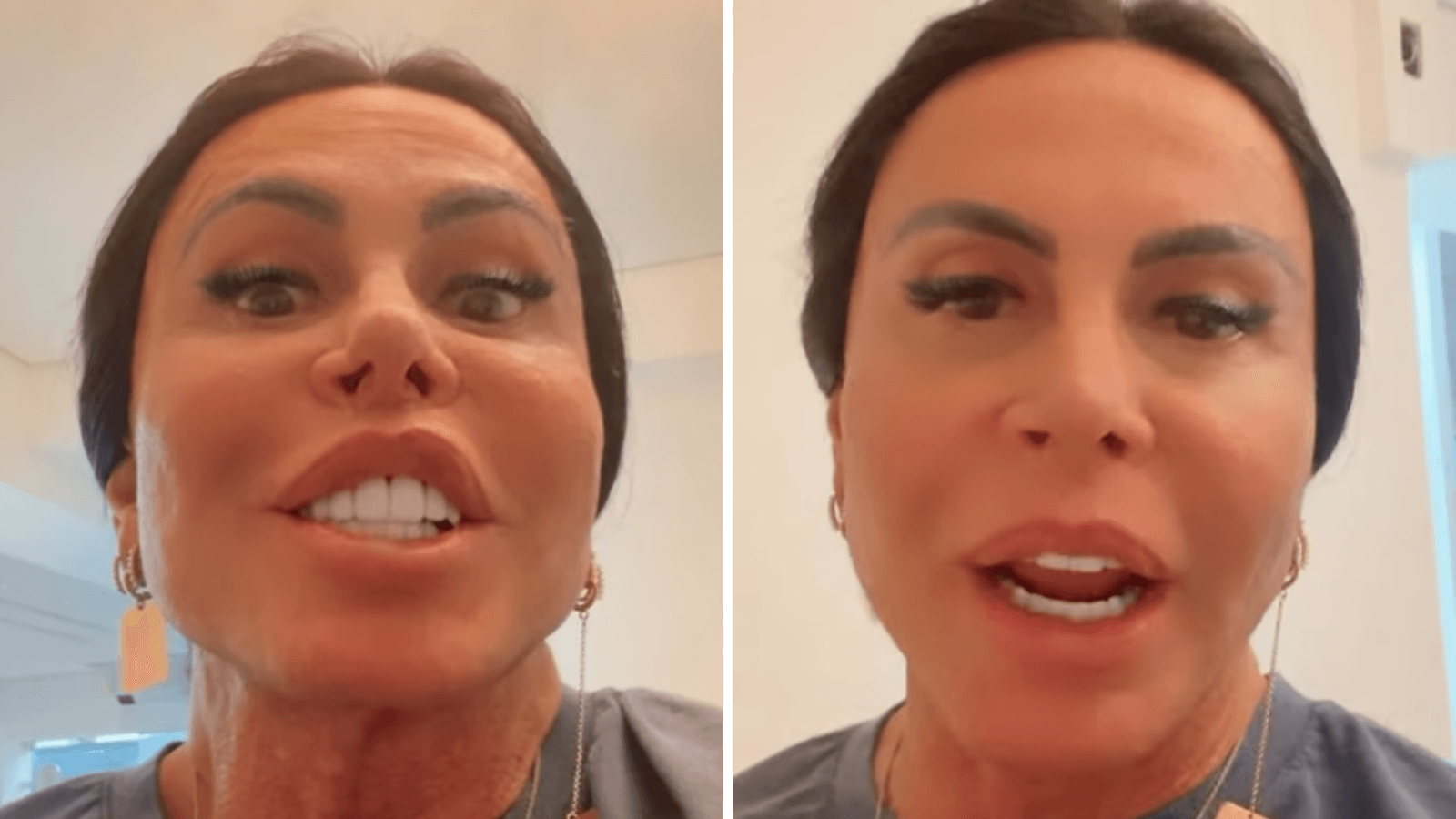 Antes de começar transplante capilar, Gretchen raspa cabeça em live; veja