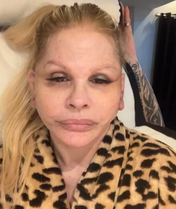 Monique Evans relata problema com o banco após cirurgia no rosto