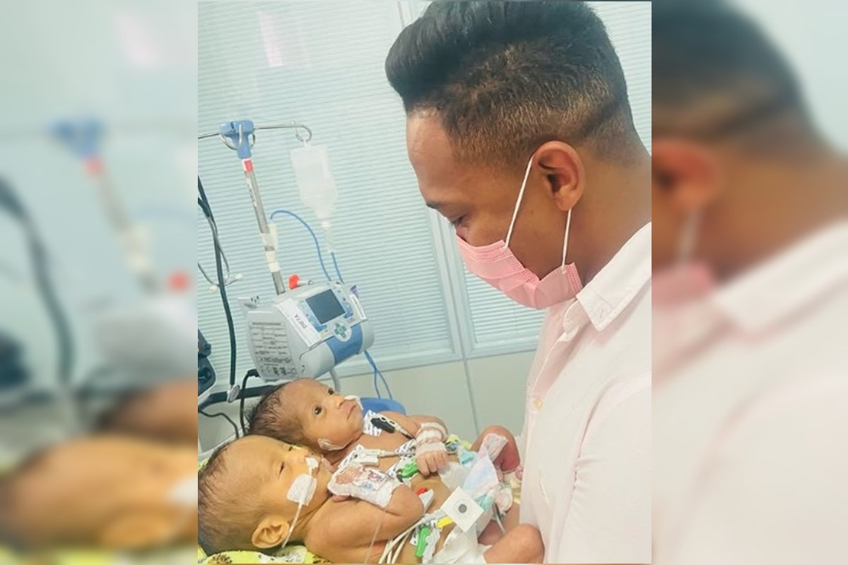 Nascidos unidos pelo abdômen, gêmeos siameses morrem em Goiânia. Veja vídeo