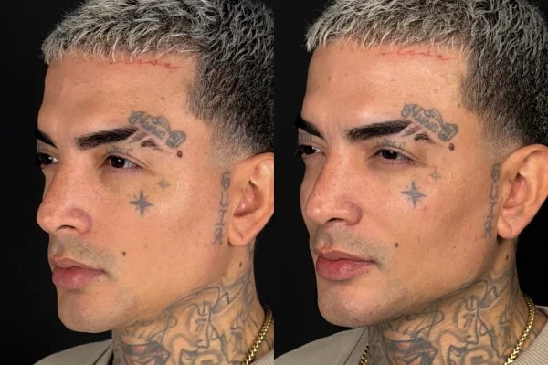 MC Guimê exibe resultado de harmonização facial. Veja antes e depois