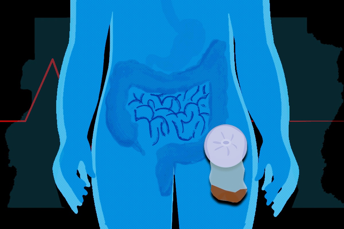 Por que pacientes que usam bolsas de colostomia temem infecção no DF