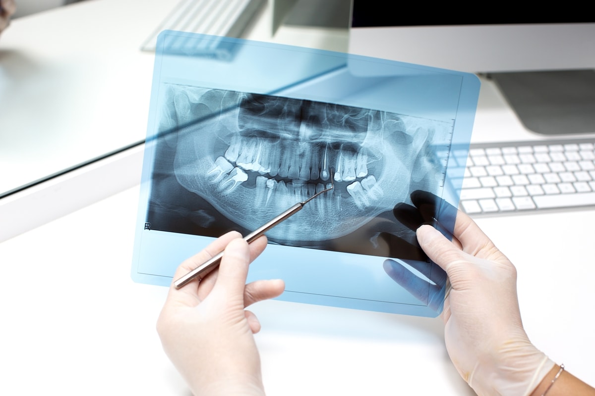 Estudo encontra 19 substâncias químicas nos dentes de crianças com autismo