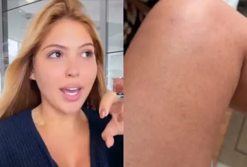 Quem é Mari Menezes, 'sósia' de Virginia que tem urticária espontânea