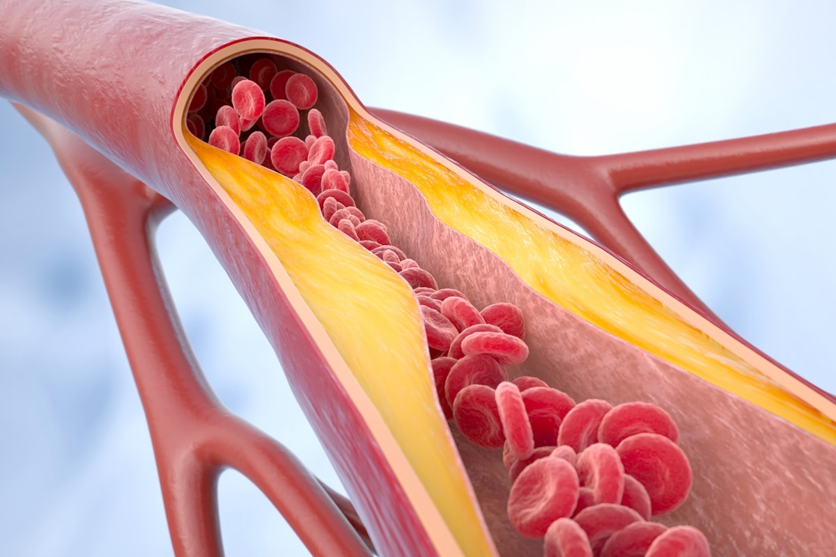 Por que reduzir o colesterol LDL é decisivo para proteger o coração