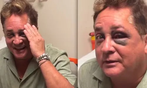 Leonardo sofre acidente e surge com olho deformada; saiba estado