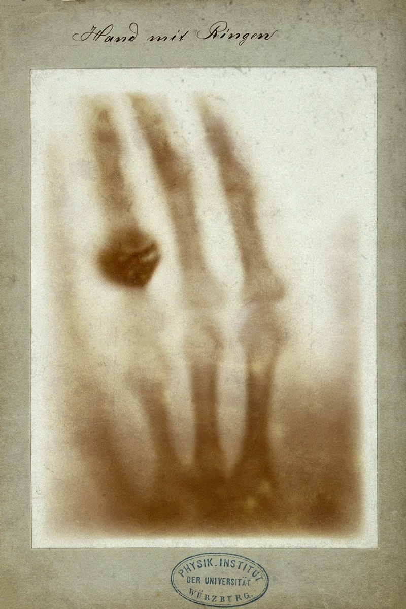 Descoberto há 130 anos, raio-X continua revolucionando a medicina