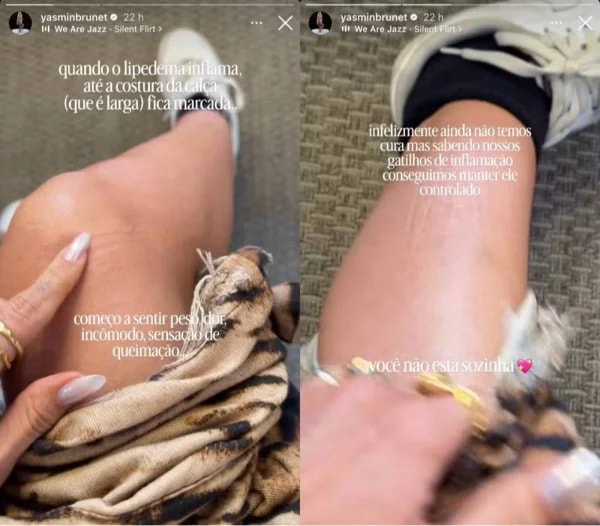Yasmin Brunet exibe marcas do lipedema e relata dor e queimação