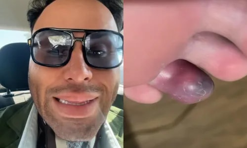 Participante desiste do Masterchef Brasil após ser picado por aranha