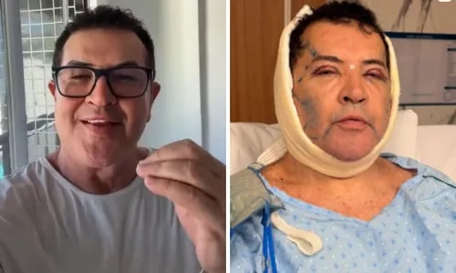 Beto Barbosa reaparece após cirurgia plástica no rosto aos 71 anos; VÍDEO