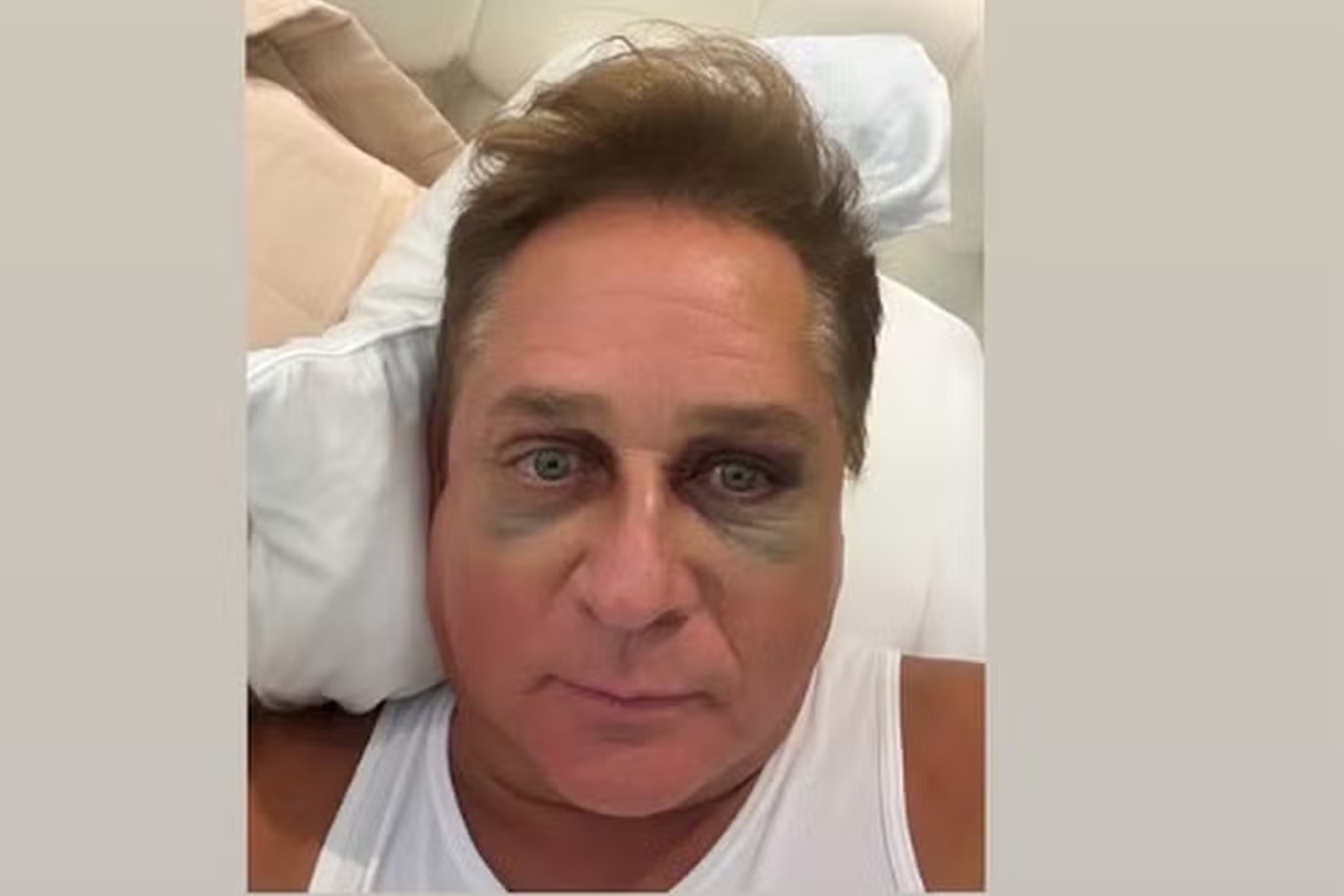 Leonardo segue com olho roxo após acidente. Veja novas fotos do cantor
