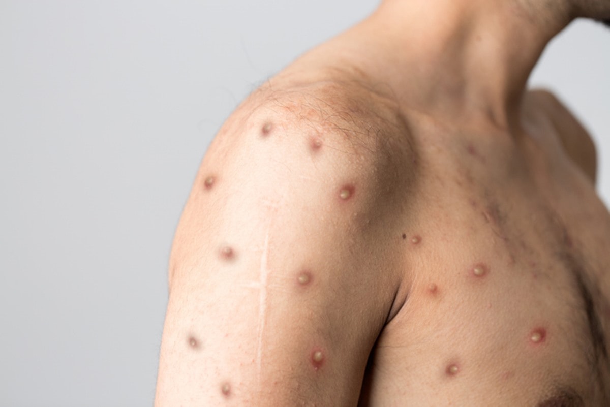 Rio de Janeiro registra 74 casos de Mpox em dois meses