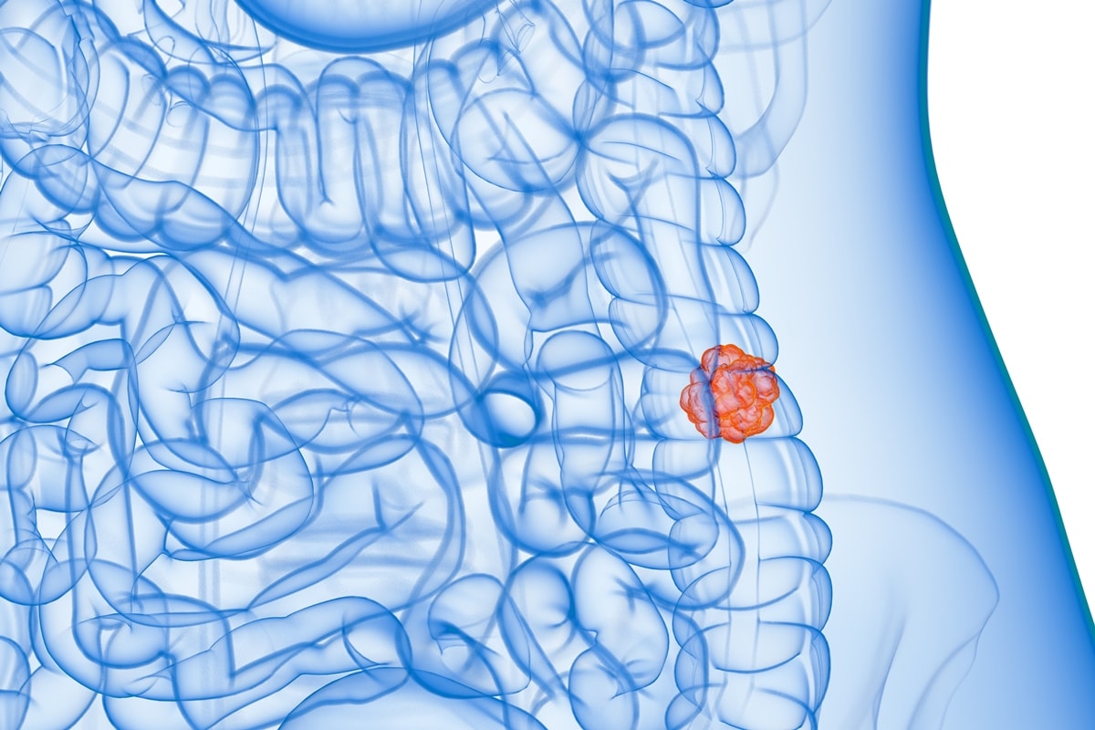 Conheça alteração silenciosa no intestino que pode evoluir para câncer