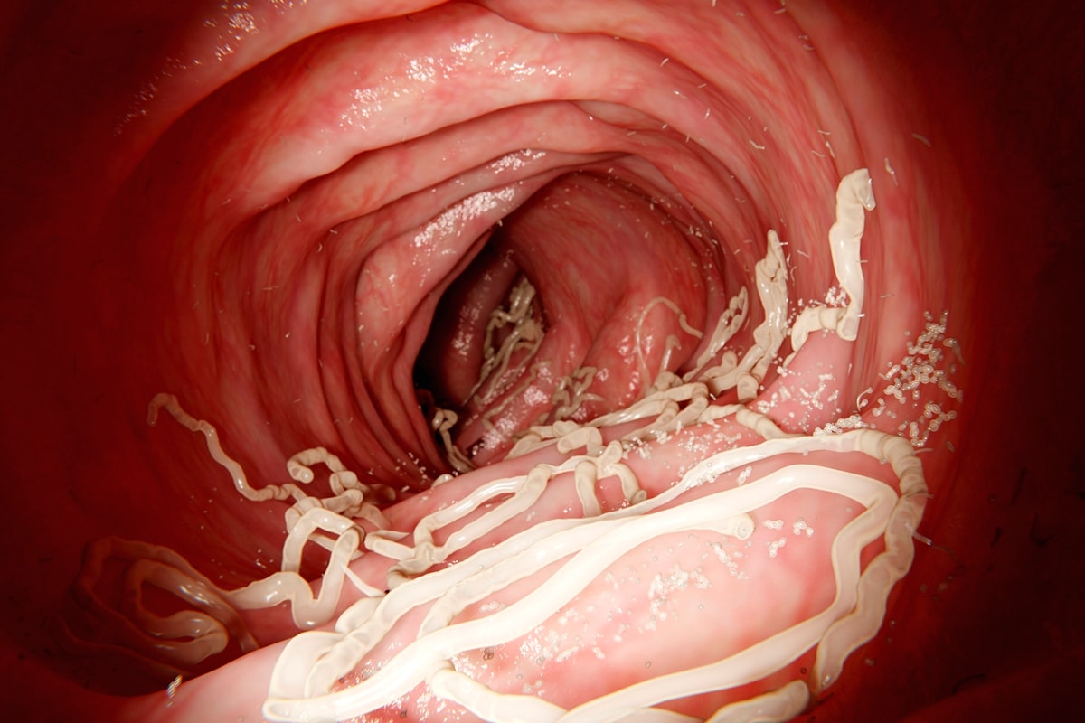 Infectologista cita sinais silenciosos da contaminação por vermes