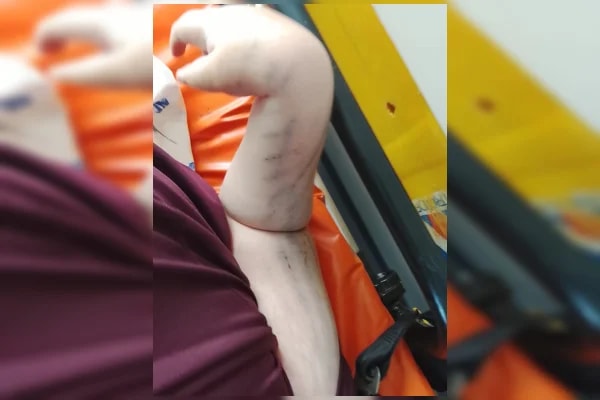 Menino com paralisia que caiu na escada do Metrô passará por cirurgia